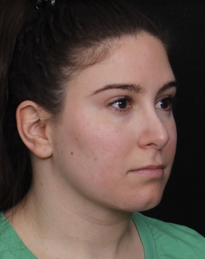 Face & Neck Lift Before & After Gallery - Patient 886848 - Image 4