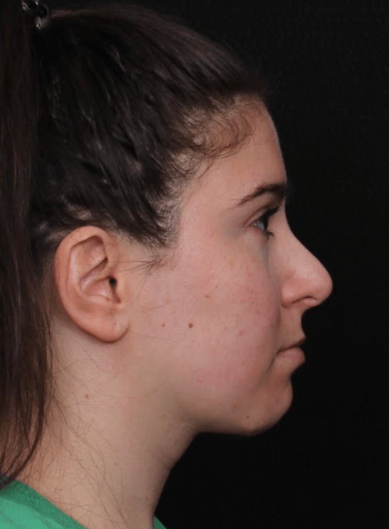 Face & Neck Lift Before & After Gallery - Patient 886848 - Image 8
