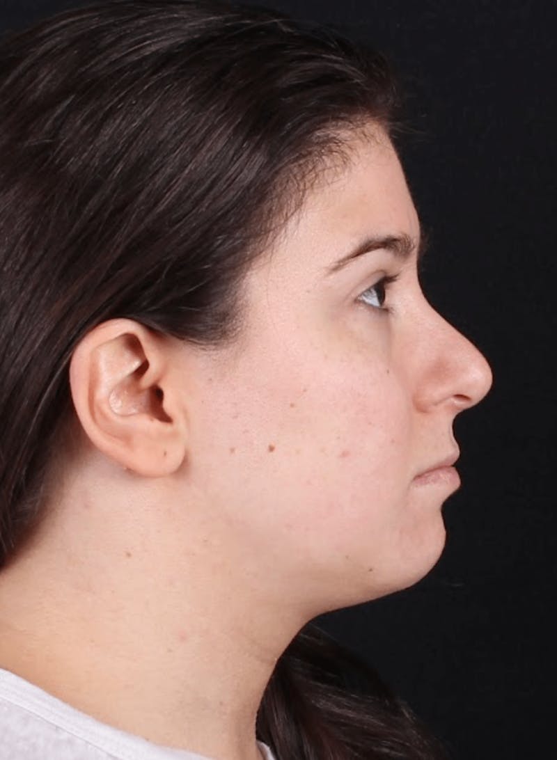 Face & Neck Lift Before & After Gallery - Patient 886848 - Image 7