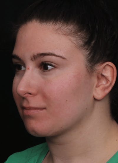 Face & Neck Lift Before & After Gallery - Patient 886848 - Image 2