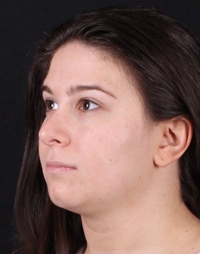 Face & Neck Lift Before & After Gallery - Patient 886848 - Image 1