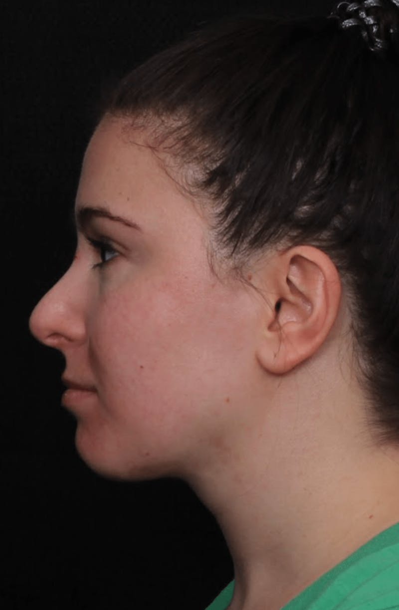 Face & Neck Lift Before & After Gallery - Patient 886848 - Image 10