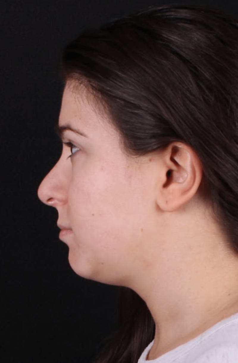 Face & Neck Lift Before & After Gallery - Patient 886848 - Image 9