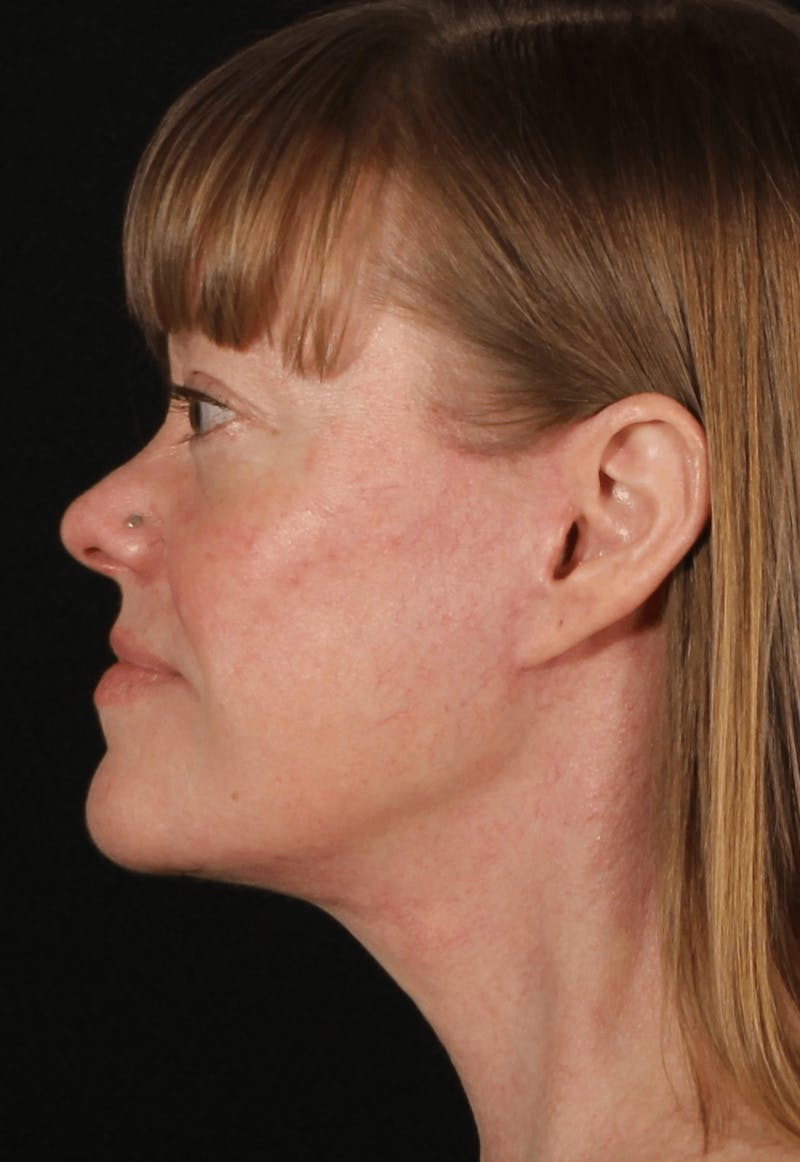 Face & Neck Lift Before & After Gallery - Patient 257069 - Image 4