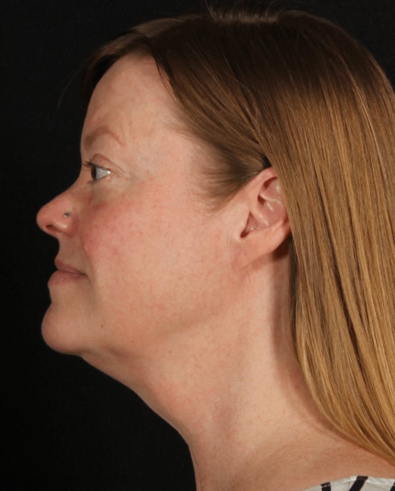 Face & Neck Lift Before & After Gallery - Patient 257069 - Image 3