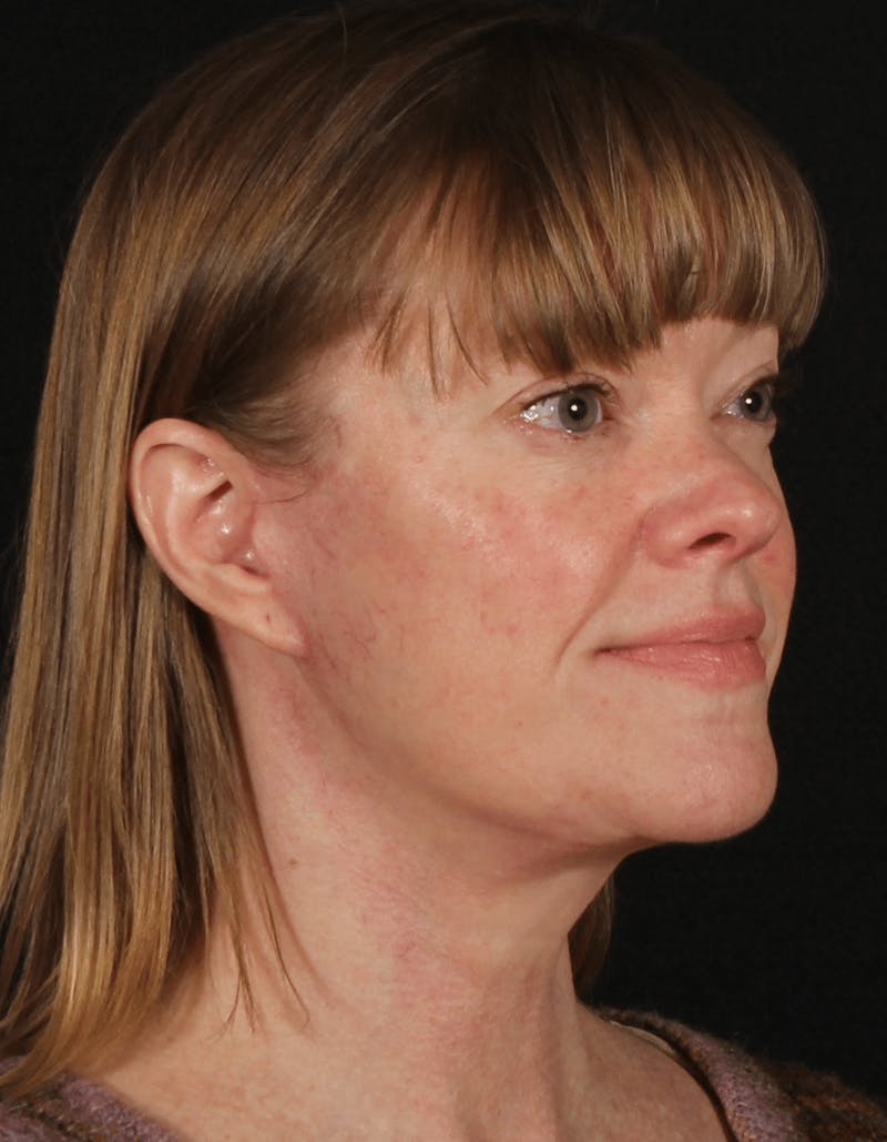 Face & Neck Lift Before & After Gallery - Patient 257069 - Image 8