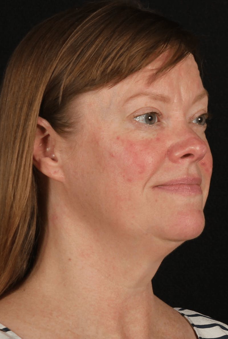 Face & Neck Lift Before & After Gallery - Patient 257069 - Image 7
