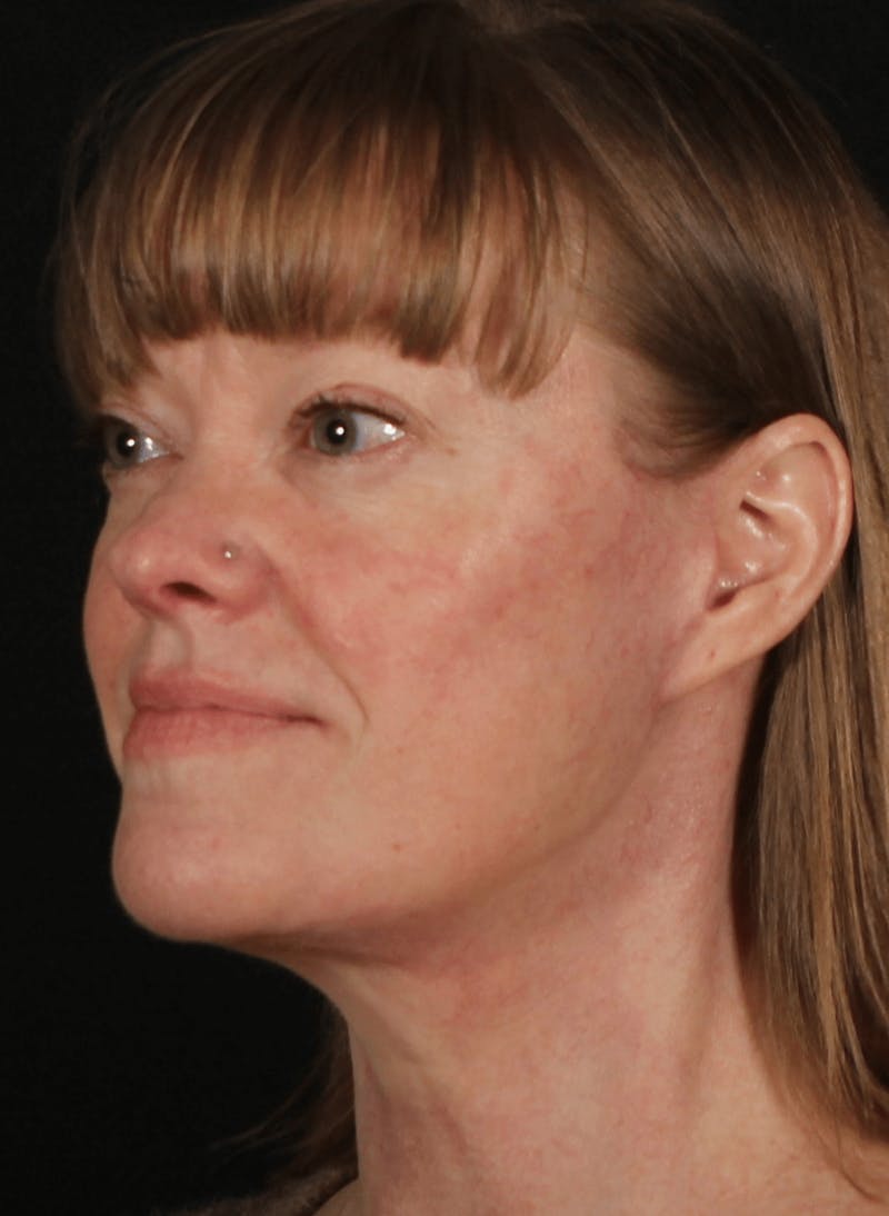 Face & Neck Lift Before & After Gallery - Patient 257069 - Image 2
