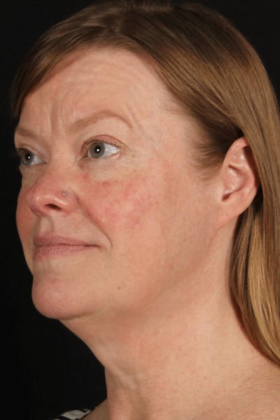 Face & Neck Lift Before & After Gallery - Patient 257069 - Image 1