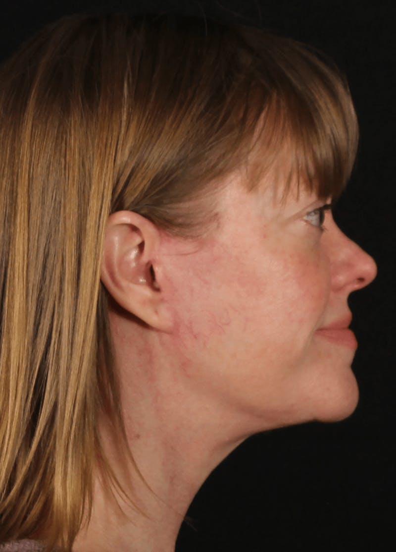 Face & Neck Lift Before & After Gallery - Patient 257069 - Image 10