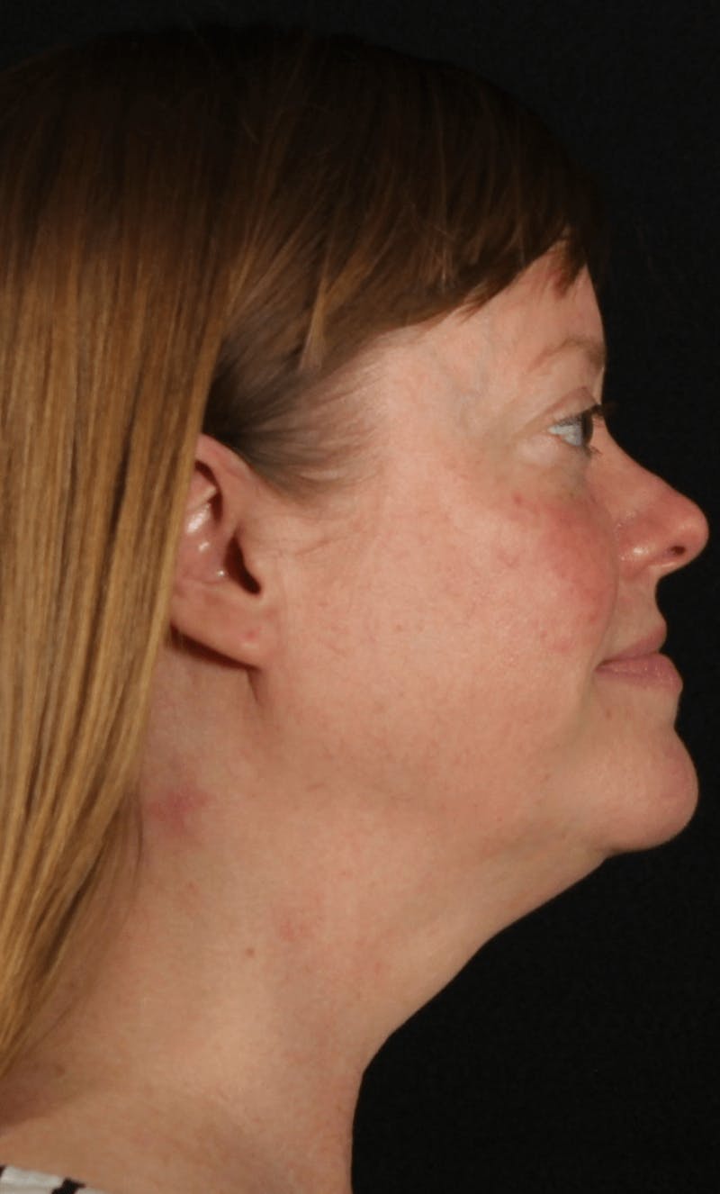 Face & Neck Lift Before & After Gallery - Patient 257069 - Image 9