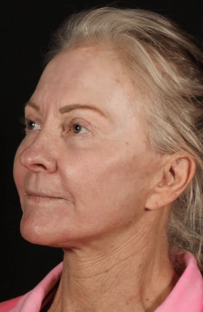 Face & Neck Lift Before & After Gallery - Patient 423522 - Image 2