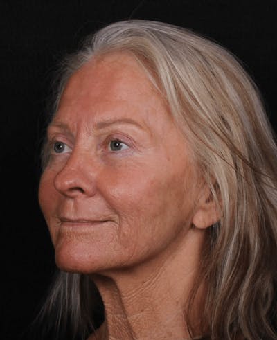 Face & Neck Lift Before & After Gallery - Patient 423522 - Image 1