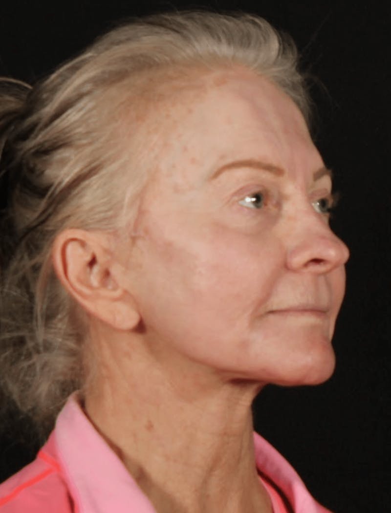 Face & Neck Lift Before & After Gallery - Patient 423522 - Image 4