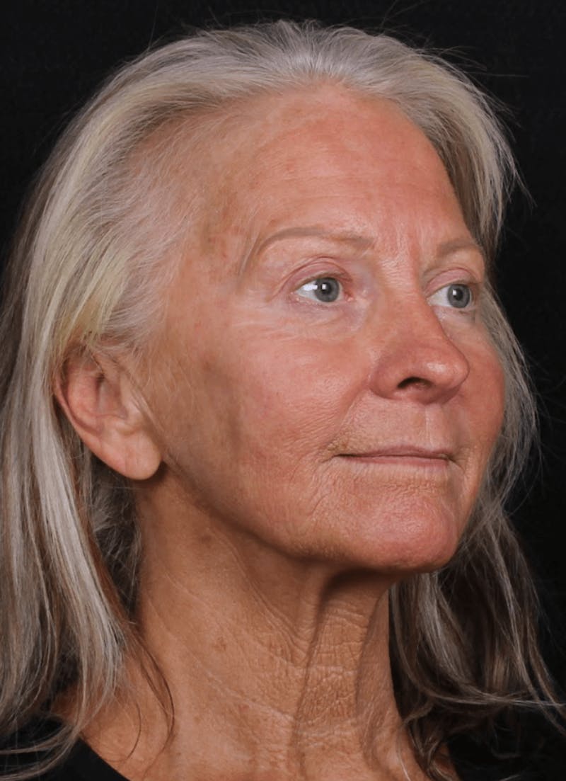 Face & Neck Lift Before & After Gallery - Patient 423522 - Image 3