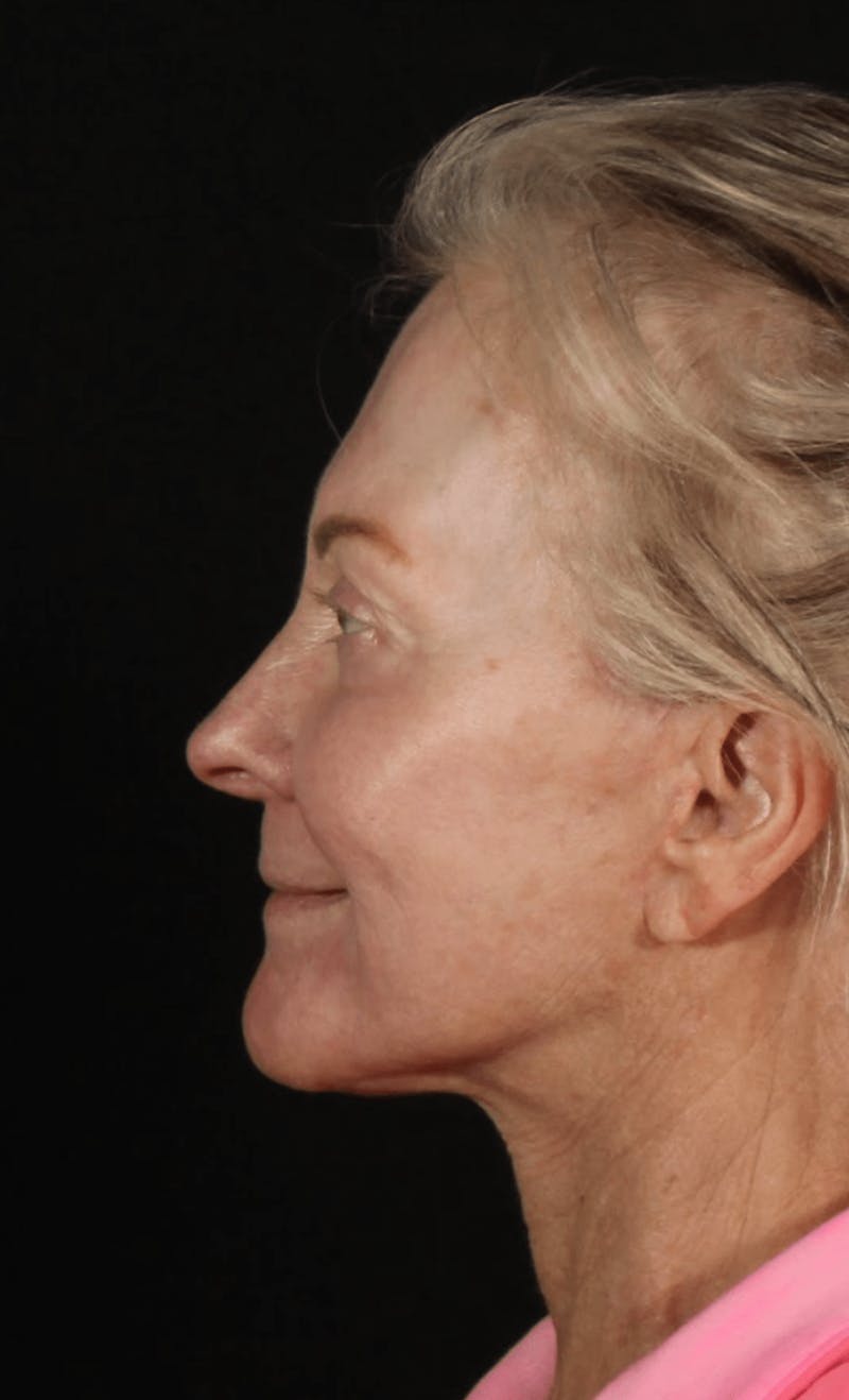 Face & Neck Lift Before & After Gallery - Patient 423522 - Image 6