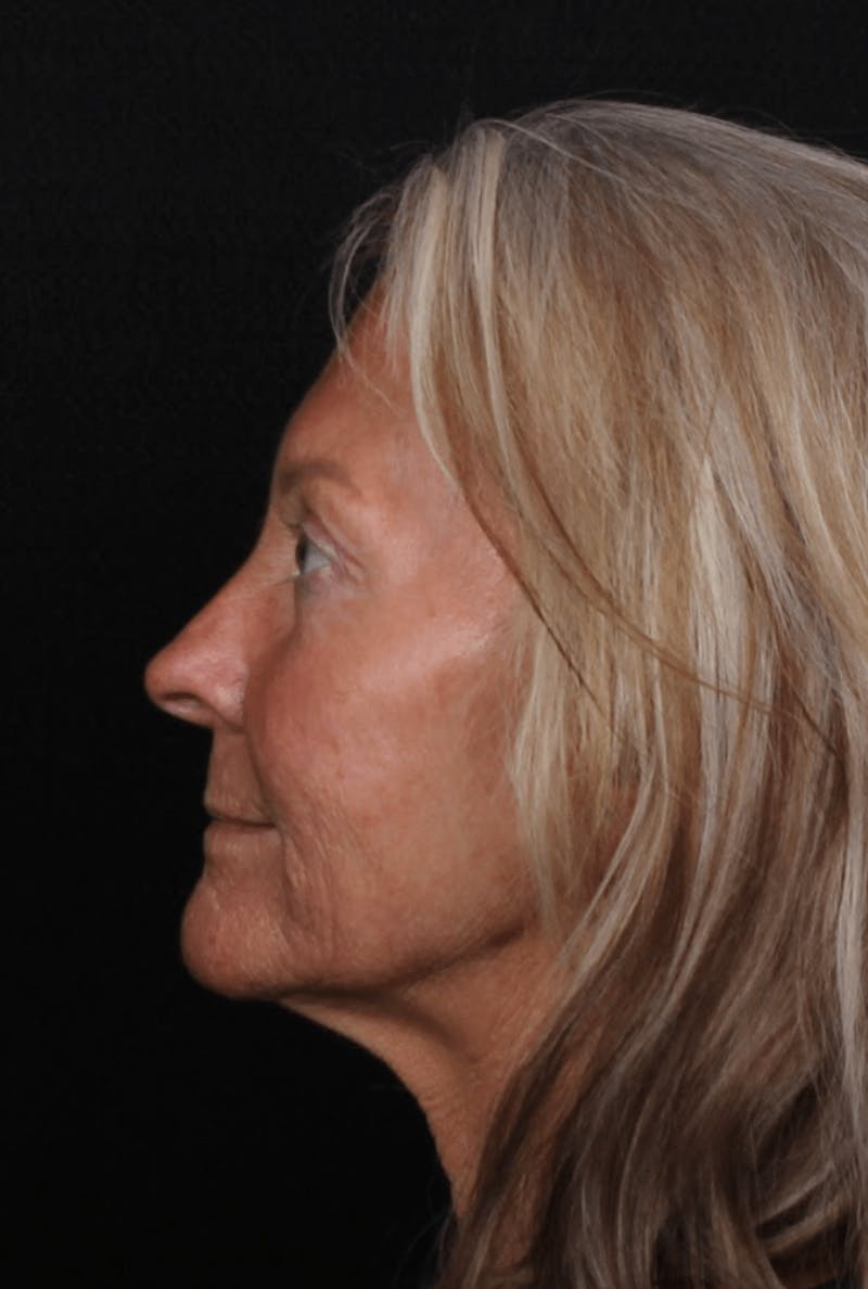 Face & Neck Lift Before & After Gallery - Patient 423522 - Image 5