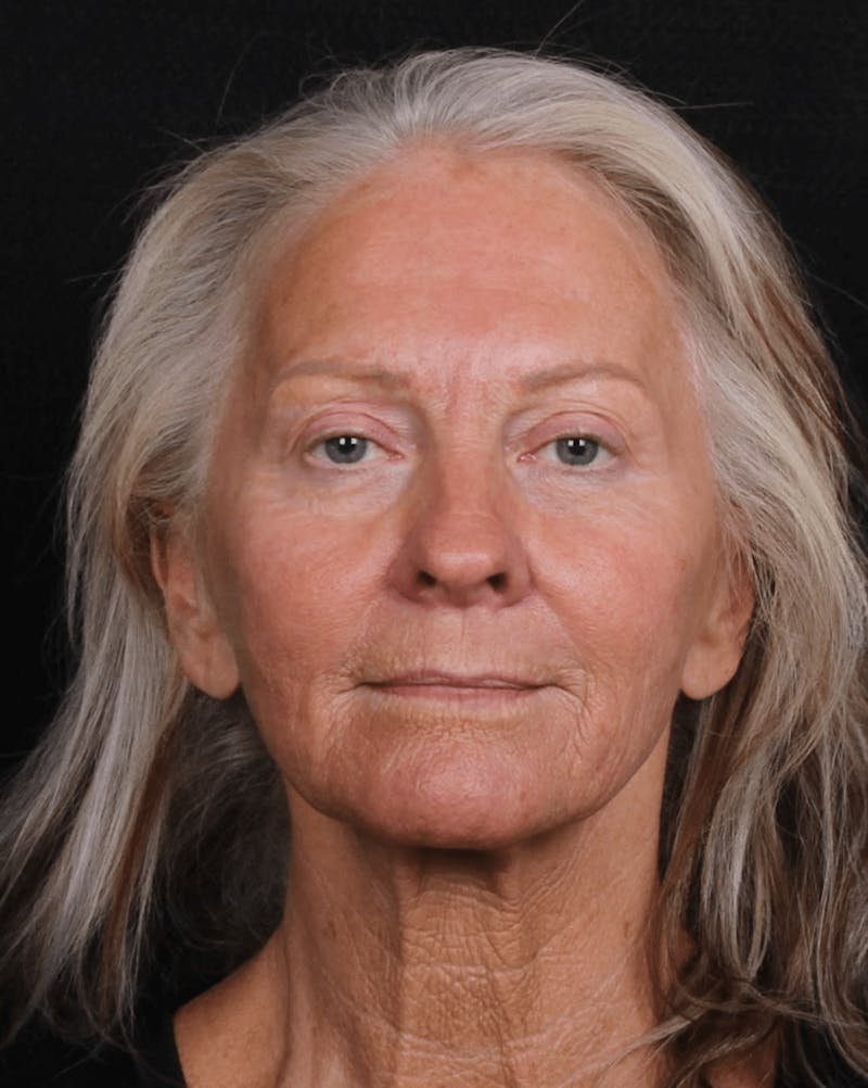 Face & Neck Lift Before & After Gallery - Patient 423522 - Image 7