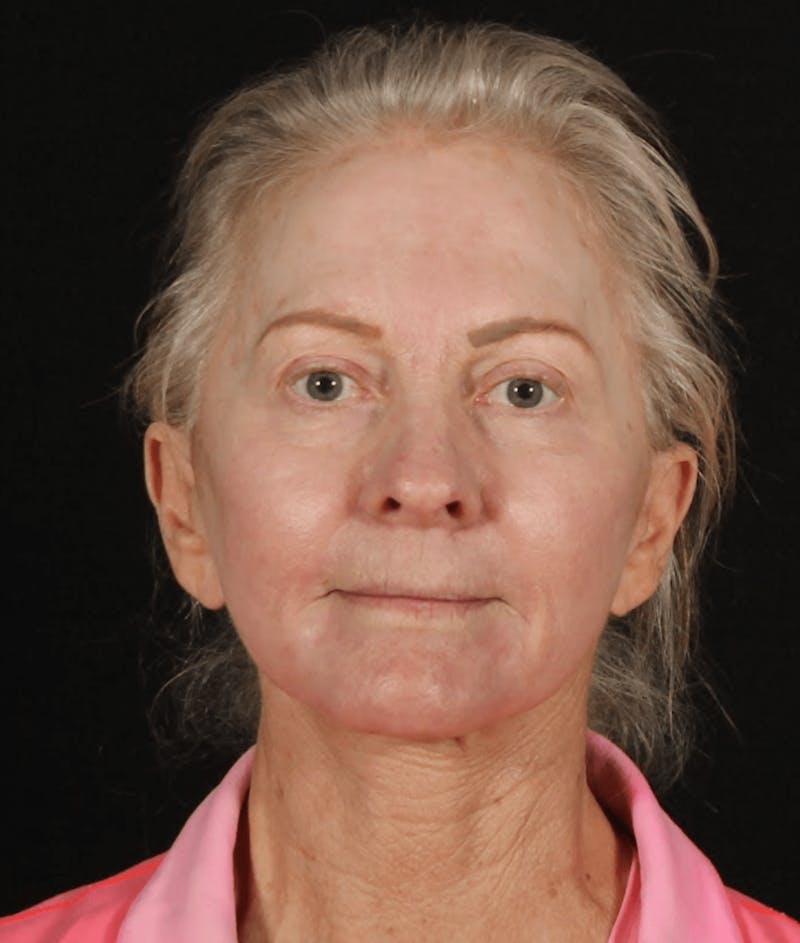 Face & Neck Lift Before & After Gallery - Patient 423522 - Image 8