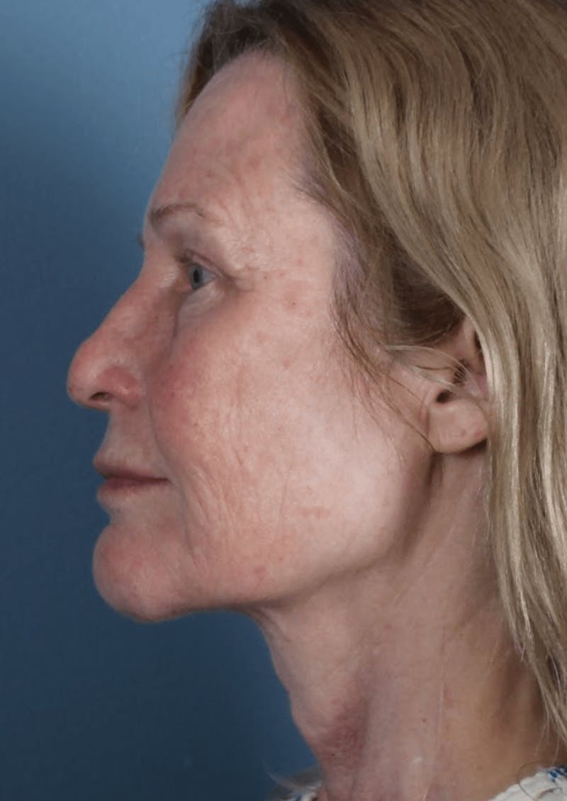 Face & Neck Lift Before & After Gallery - Patient 370971 - Image 4