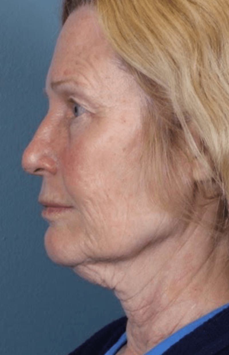 Face & Neck Lift Before & After Gallery - Patient 370971 - Image 3