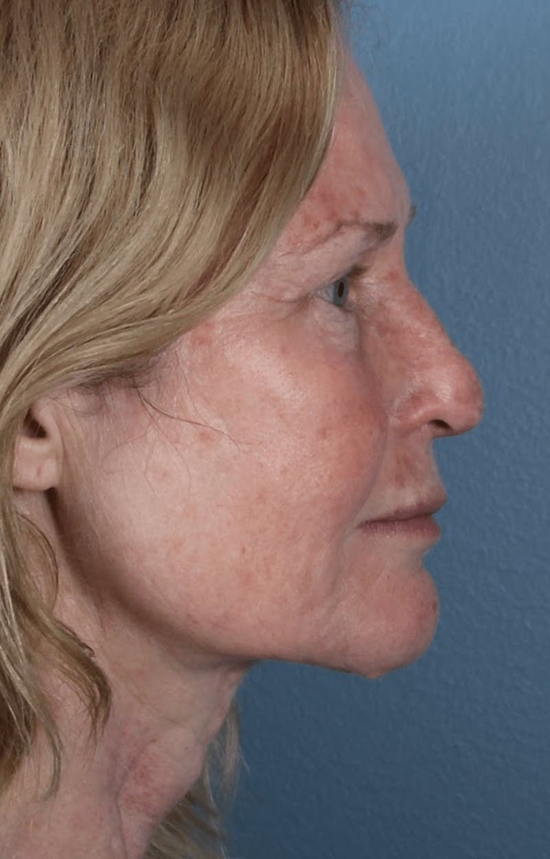 Face & Neck Lift Before & After Gallery - Patient 370971 - Image 6