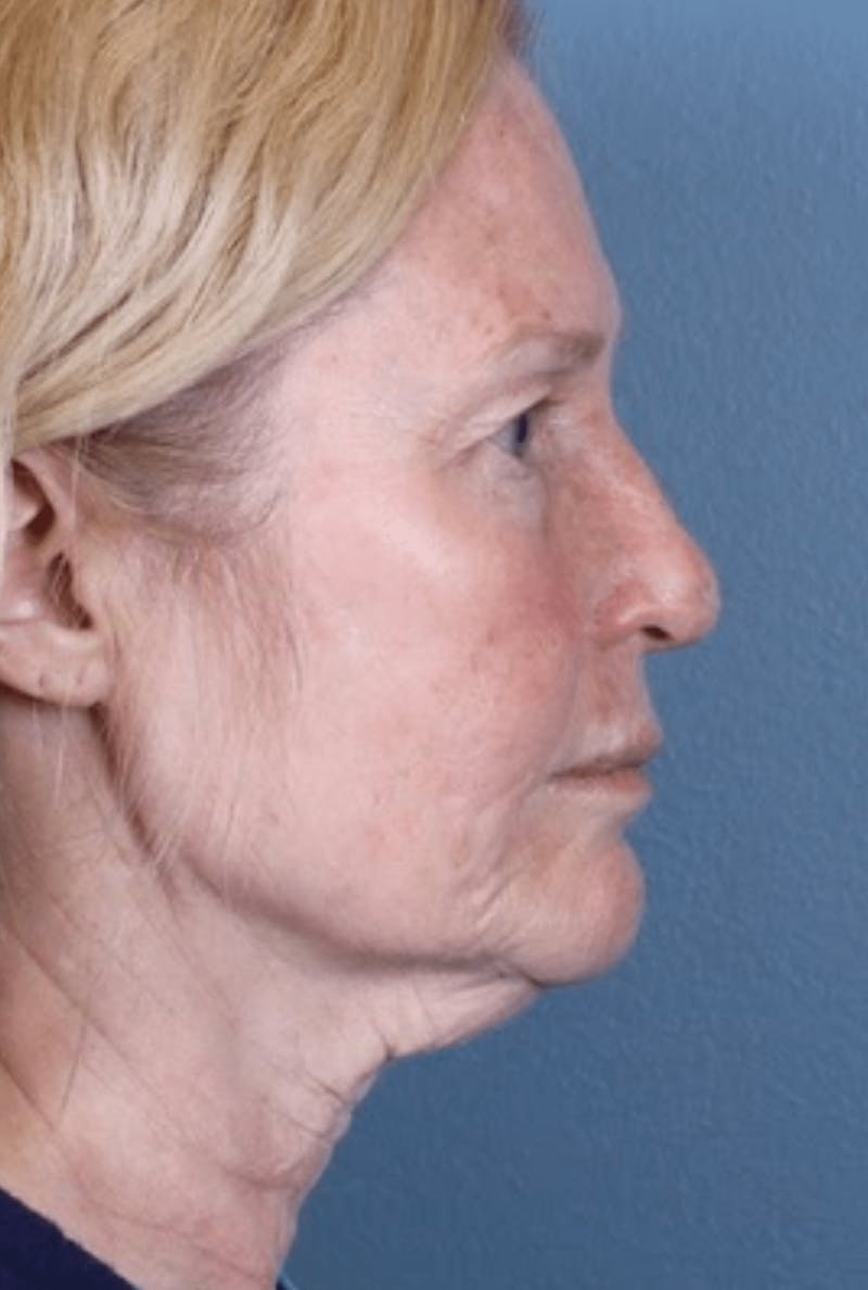 Face & Neck Lift Before & After Gallery - Patient 370971 - Image 5