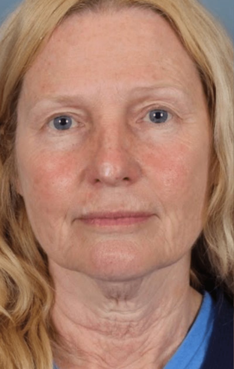 Face & Neck Lift Before & After Gallery - Patient 370971 - Image 7