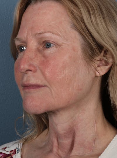 Face & Neck Lift Before & After Gallery - Patient 370971 - Image 2