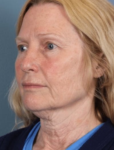 Face & Neck Lift Before & After Gallery - Patient 370971 - Image 1