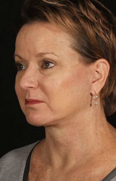 Face & Neck Lift Before & After Gallery - Patient 471192 - Image 2