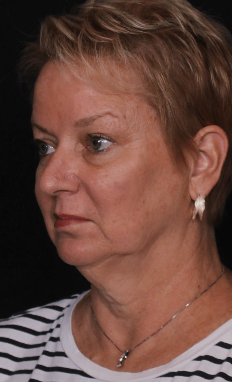 Face & Neck Lift Before & After Gallery - Patient 471192 - Image 1