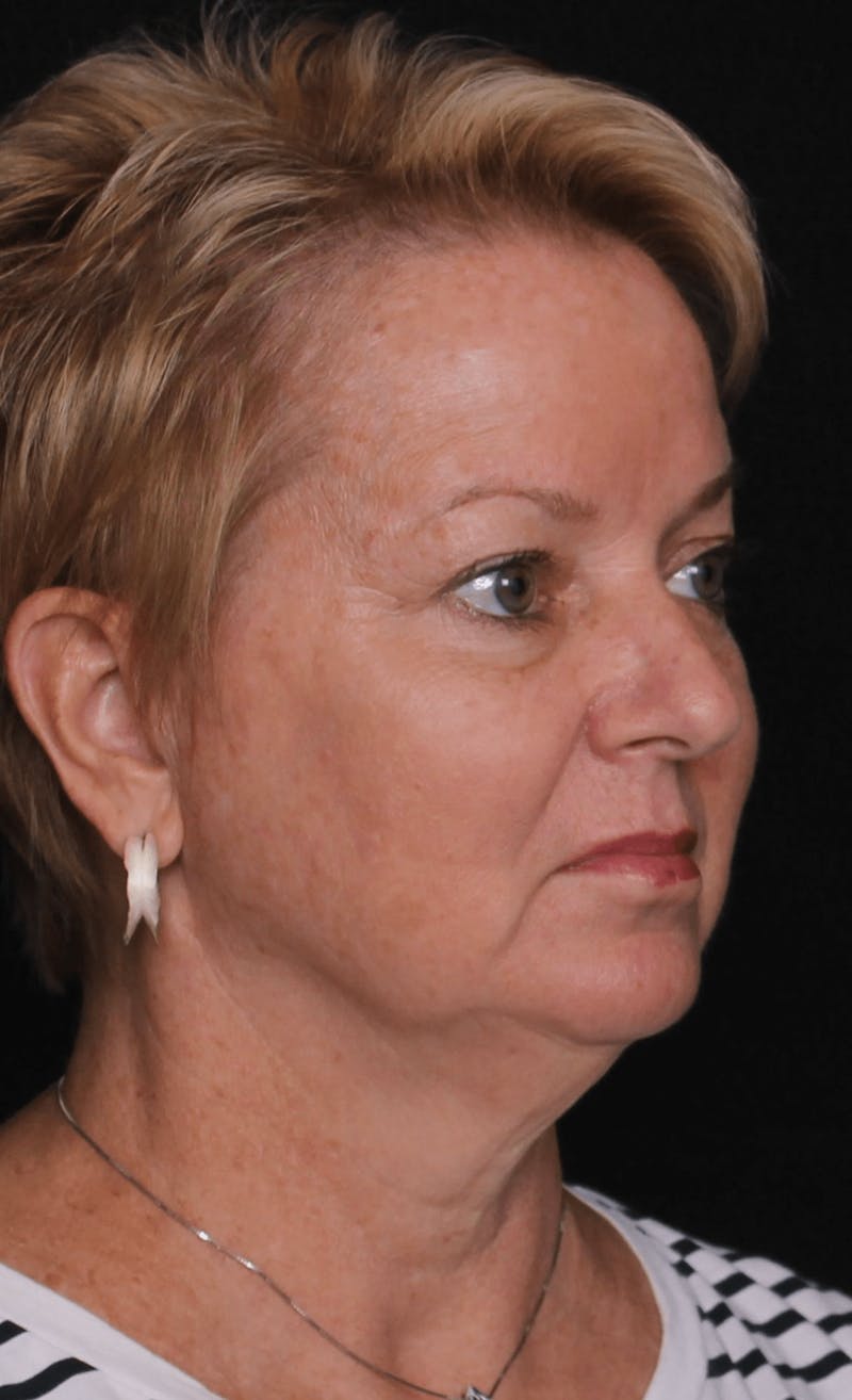 Face & Neck Lift Before & After Gallery - Patient 471192 - Image 3