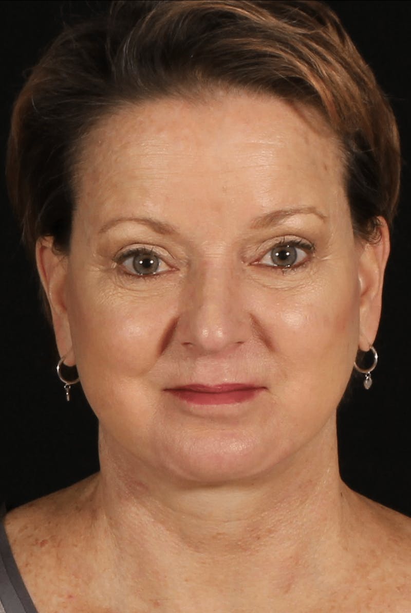 Face & Neck Lift Before & After Gallery - Patient 471192 - Image 6