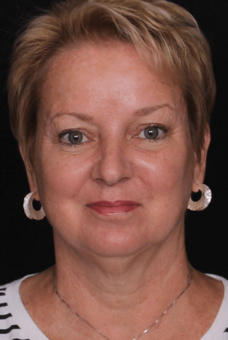 Face & Neck Lift Before & After Gallery - Patient 471192 - Image 5
