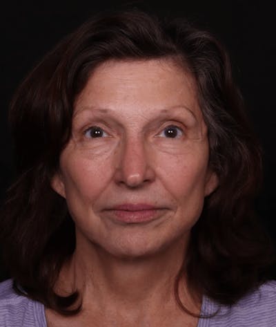Face & Neck Lift Before & After Gallery - Patient 412004 - Image 2