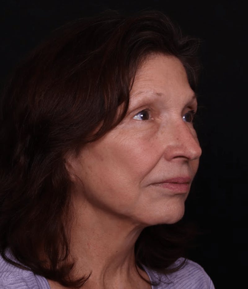 Face & Neck Lift Before & After Gallery - Patient 412004 - Image 4