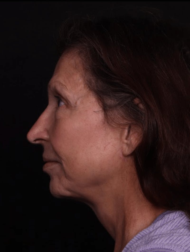Face & Neck Lift Before & After Gallery - Patient 412004 - Image 6