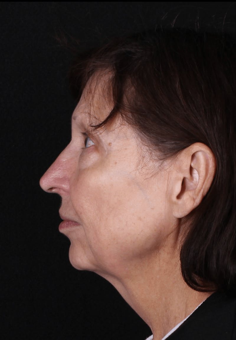 Face & Neck Lift Before & After Gallery - Patient 412004 - Image 5