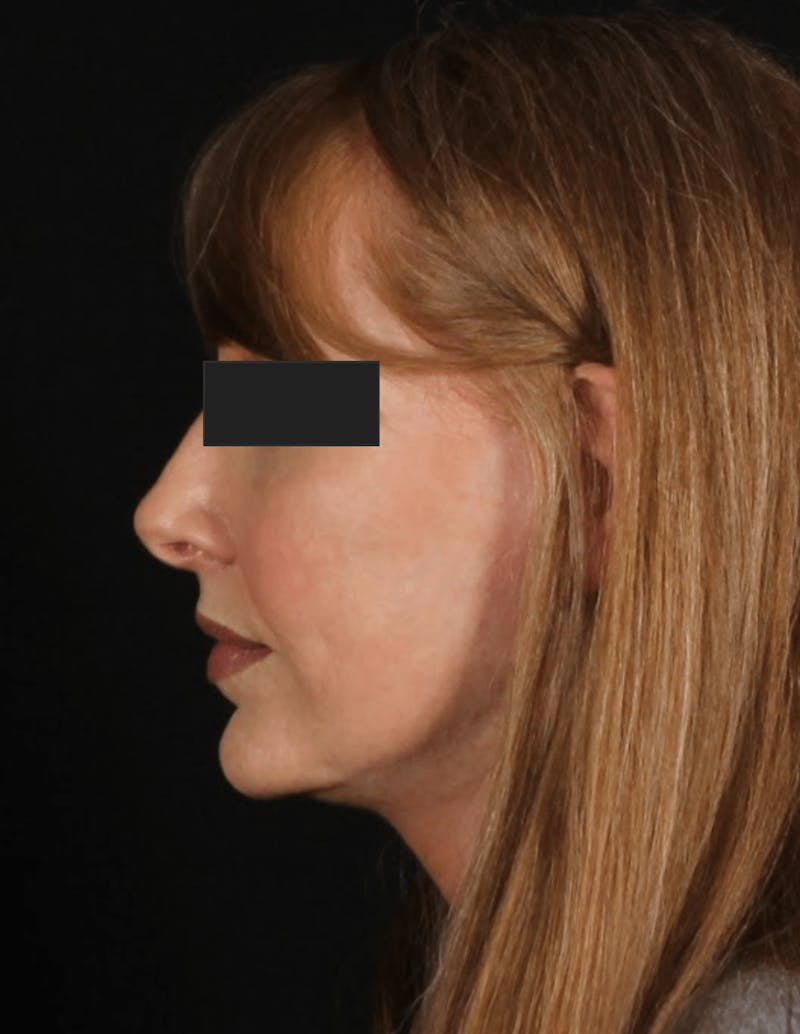Face & Neck Lift Before & After Gallery - Patient 169174 - Image 4