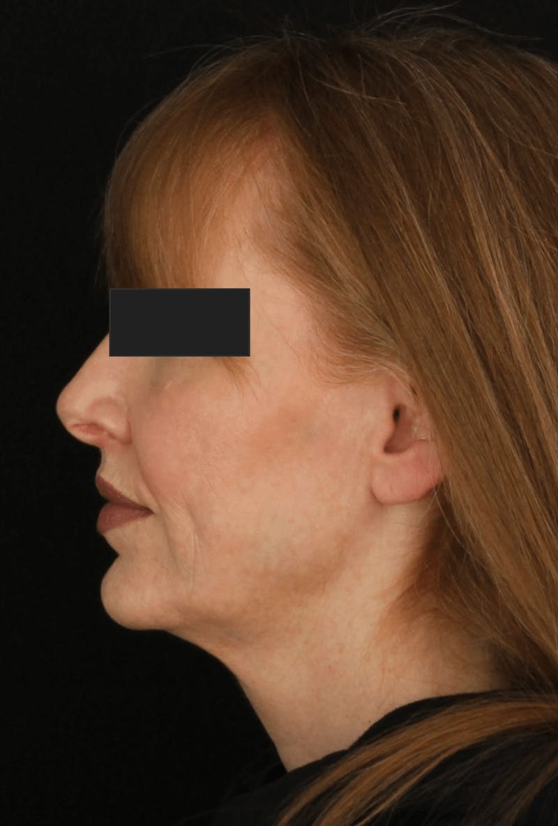 Face & Neck Lift Before & After Gallery - Patient 169174 - Image 3
