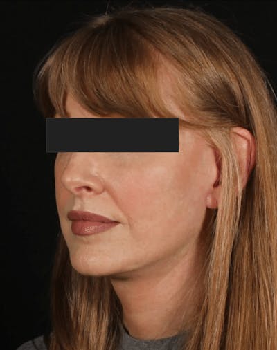 Face & Neck Lift Before & After Gallery - Patient 169174 - Image 2