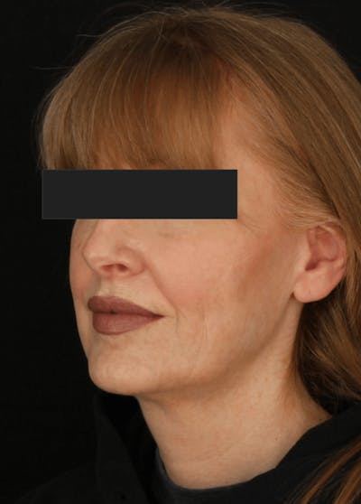 Face & Neck Lift Before & After Gallery - Patient 169174 - Image 1