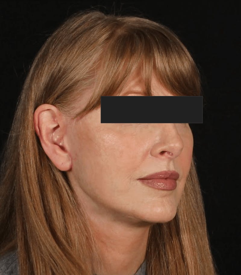 Face & Neck Lift Before & After Gallery - Patient 169174 - Image 6