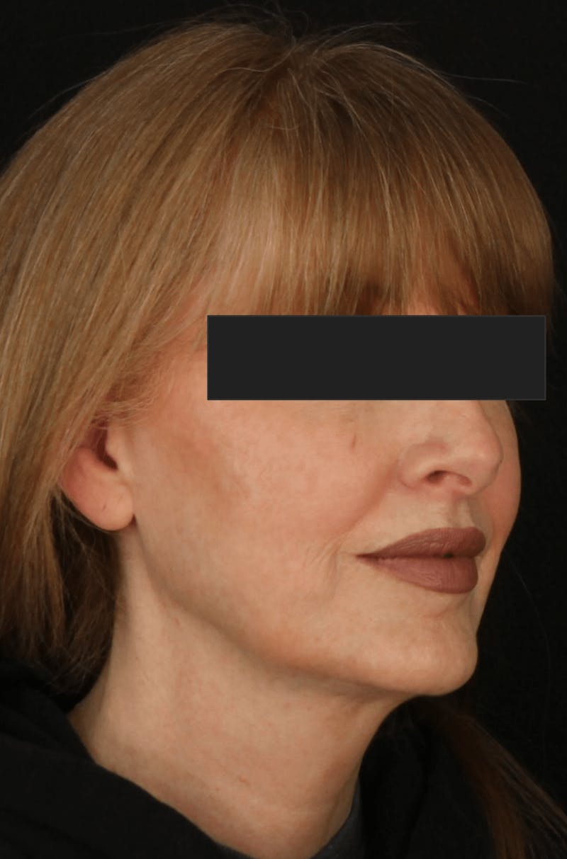 Face & Neck Lift Before & After Gallery - Patient 169174 - Image 5