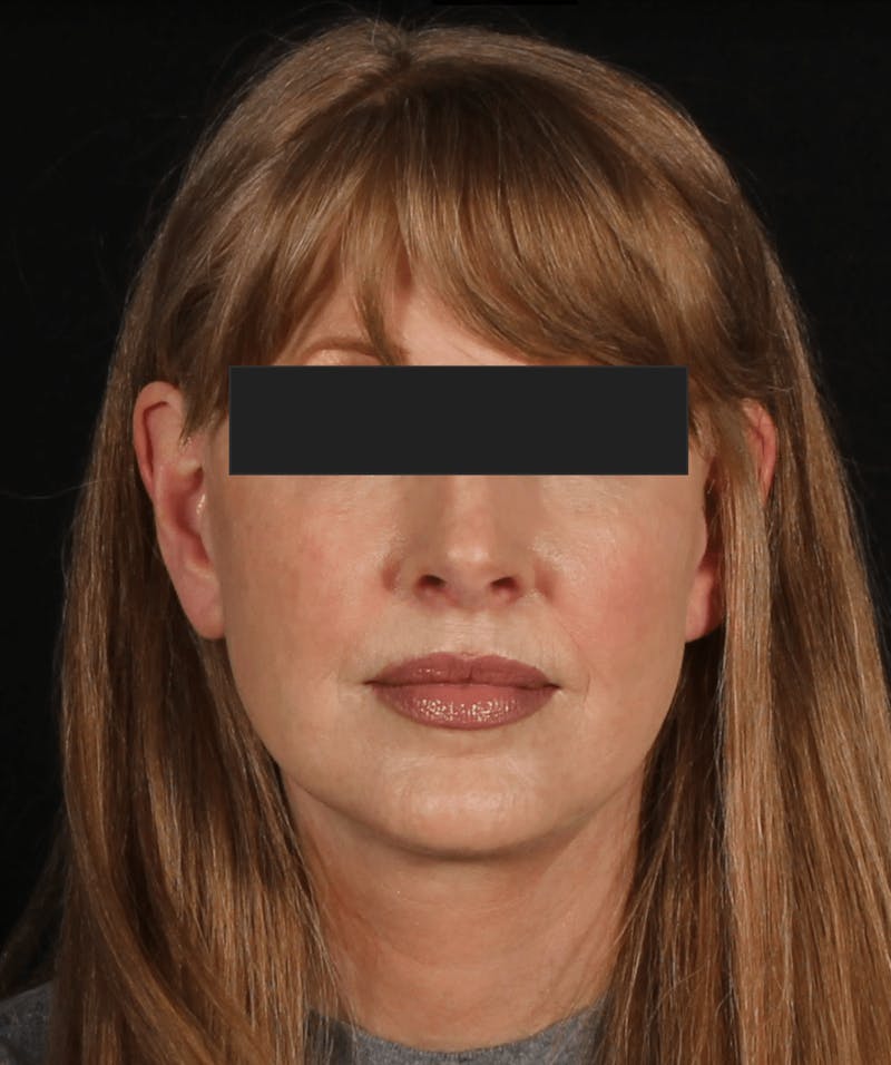 Face & Neck Lift Before & After Gallery - Patient 169174 - Image 8