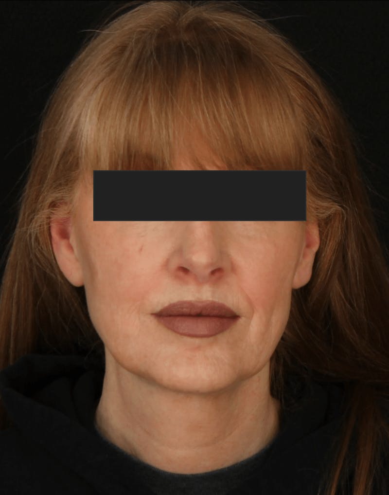 Face & Neck Lift Before & After Gallery - Patient 169174 - Image 7