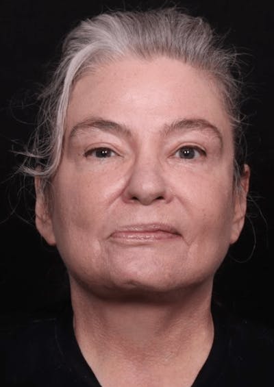 Face & Neck Lift Before & After Gallery - Patient 262727 - Image 2