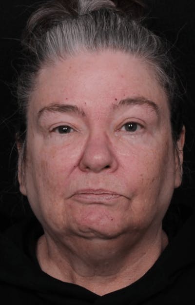 Face & Neck Lift Before & After Gallery - Patient 262727 - Image 1