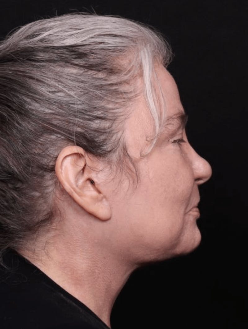 Face & Neck Lift Before & After Gallery - Patient 262727 - Image 4